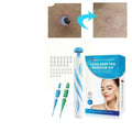 Skin Tag Removal Kit with Dual Spring Sizes and Blood Flow Restriction Method Valideals Outlet
