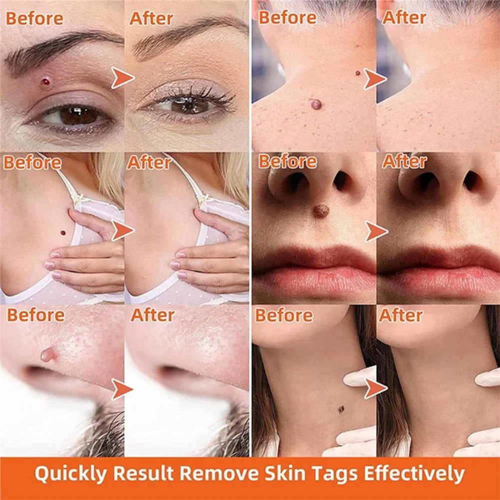 Skin Tag Removal Kit with Dual Spring Sizes and Blood Flow Restriction Method Valideals Outlet