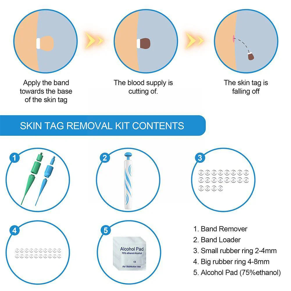 Skin Tag Removal Kit with Dual Spring Sizes and Blood Flow Restriction Method Valideals Outlet
